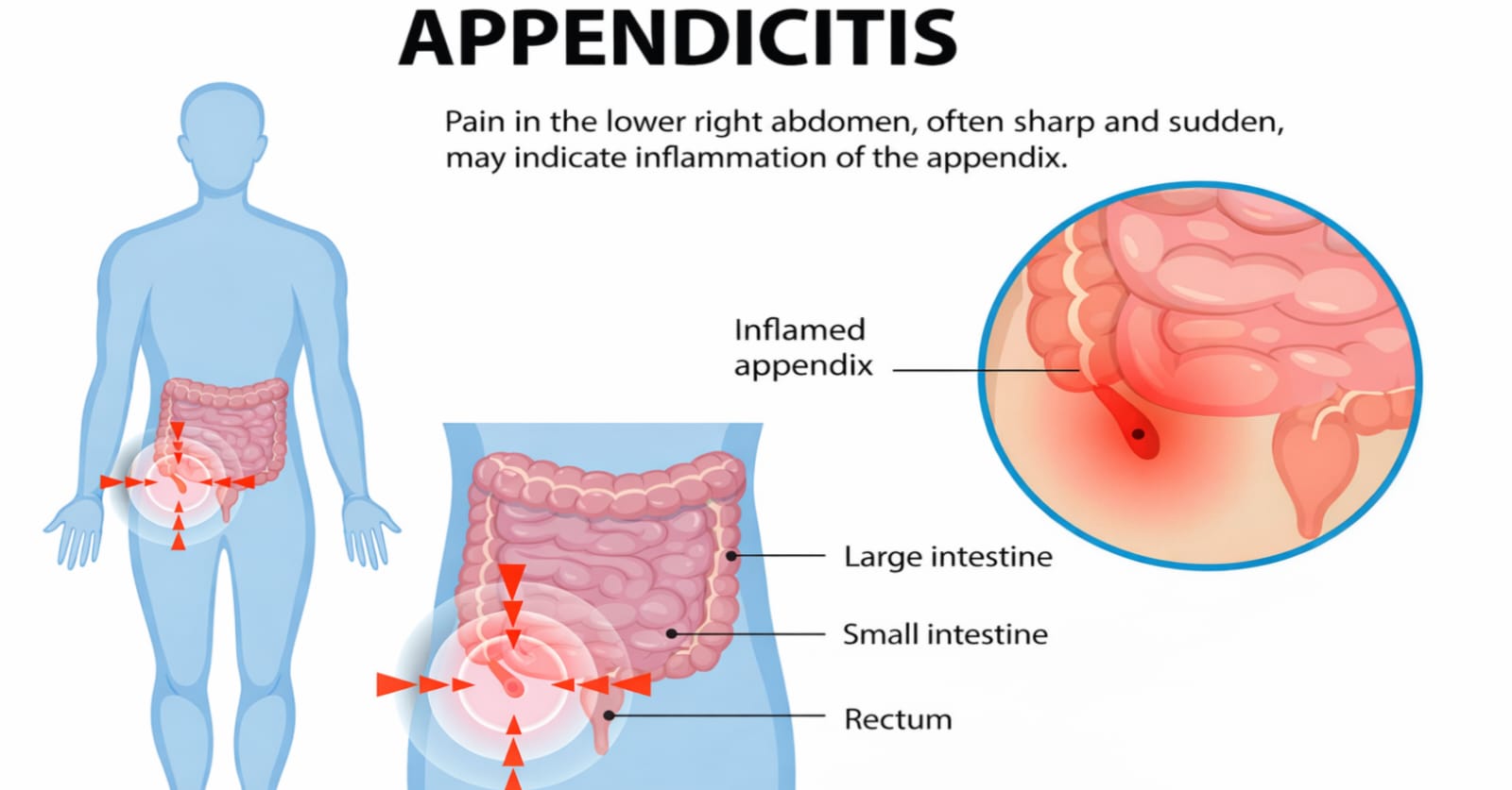 Appendicitis